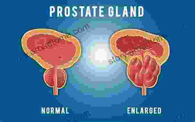 Anatomy Of The Prostate Gland Prostate Awareness: What Is The Prostate And What Is Prostate Cancer (Men S Health)