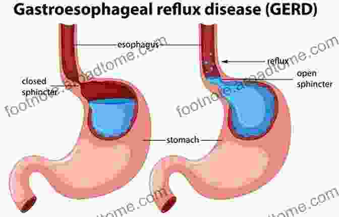 Illustration Of Acid Reflux Acid Reflux Cookbook: Easy Ingredients Acid Watcher Diet To Relief And Cure GERD LPR