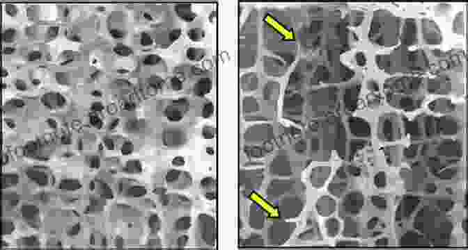 Microscopic View Of Healthy And Osteoporotic Bone OSTEOPOROSIS: A Healthy Bone Guide