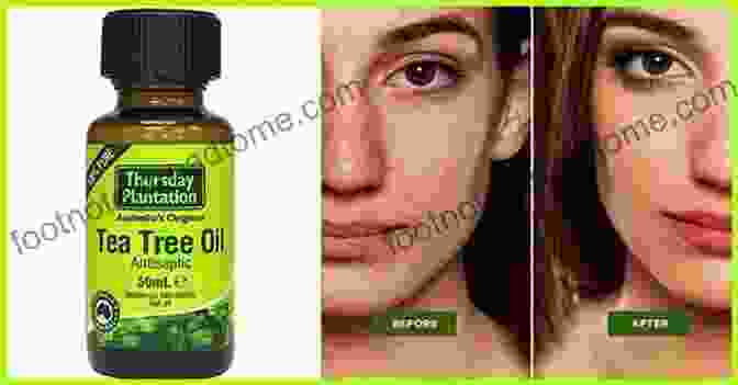 Tea Tree Oil For Acne Treatment How To Ger Rid Of Acne Scars And Pimples (Acne Treatments Acne Cure Acne Remedy Book) : Learn The Most Effective Methods And Natural Remedies To Cure Acne