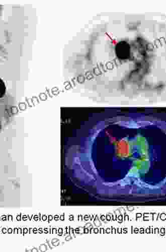 Lung Cancer An Issue Of PET Clinics (The Clinics: Radiology 13)